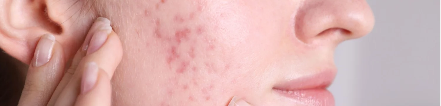 image of what are the causes of acne